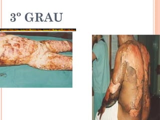 3º GRAU
 
