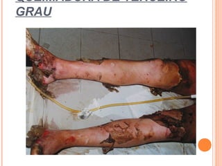 QUEIMADURA DE TERCEIRO
GRAU
 