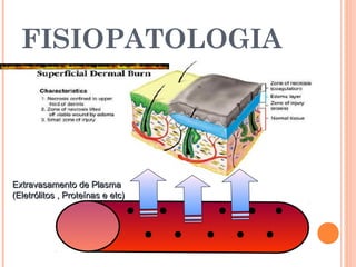 FISIOPATOLOGIA
Extravasamento de PlasmaExtravasamento de Plasma
(Eletrólitos , Proteínas e etc)(Eletrólitos , Proteínas e etc)
 