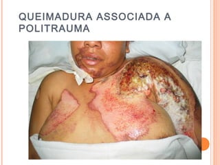 QUEIMADURA ASSOCIADA A
POLITRAUMA
 
