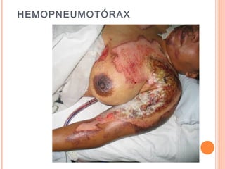 HEMOPNEUMOTÓRAX
 