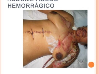 ABDOME AGUDO
HEMORRÁGICO
 