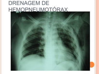 DRENAGEM DE
HEMOPNEUMOTÓRAX
 