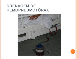 DRENAGEM DE
HEMOPNEUMOTÓRAX
 