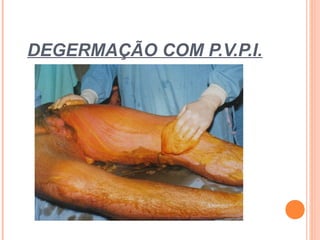DEGERMAÇÃO COM P.V.P.I.
 