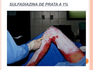 SULFADIAZINA DE PRATA A 1%
 