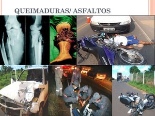 QUEIMADURAS/ ASFALTOS
 