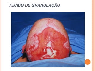 TECIDO DE GRANULAÇÃO
 