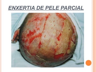 ENXERTIA DE PELE PARCIAL
 