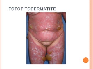 FOTOFITODERMATITE
 