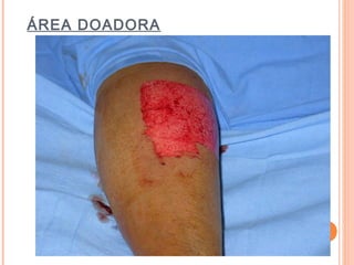 ÁREA DOADORA
 