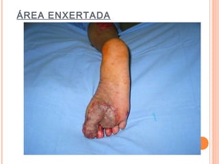 ÁREA ENXERTADA
 