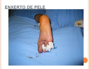 ENXERTO DE PELE
 