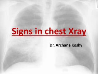 Signs in chest Xray
Dr. Archana Koshy
 
