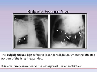 arch-k-signs-in-chest-xray-160210003601.pptx