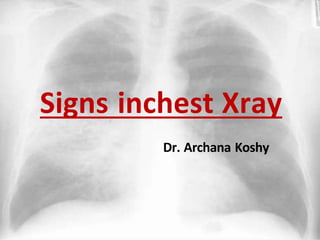 Signs inchest Xray
Dr. Archana Koshy
 
