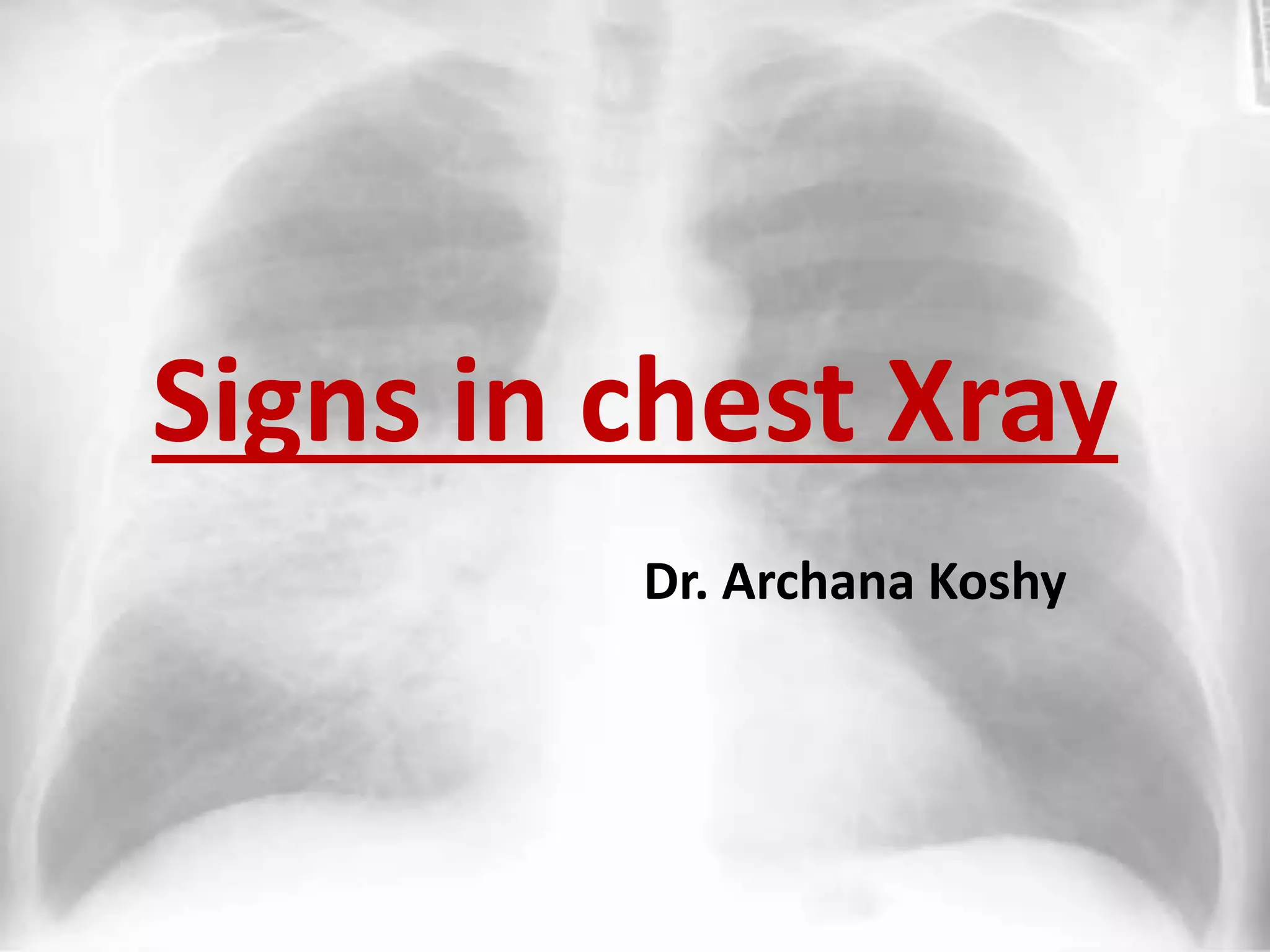 Signs in Chest Xray | PPTX