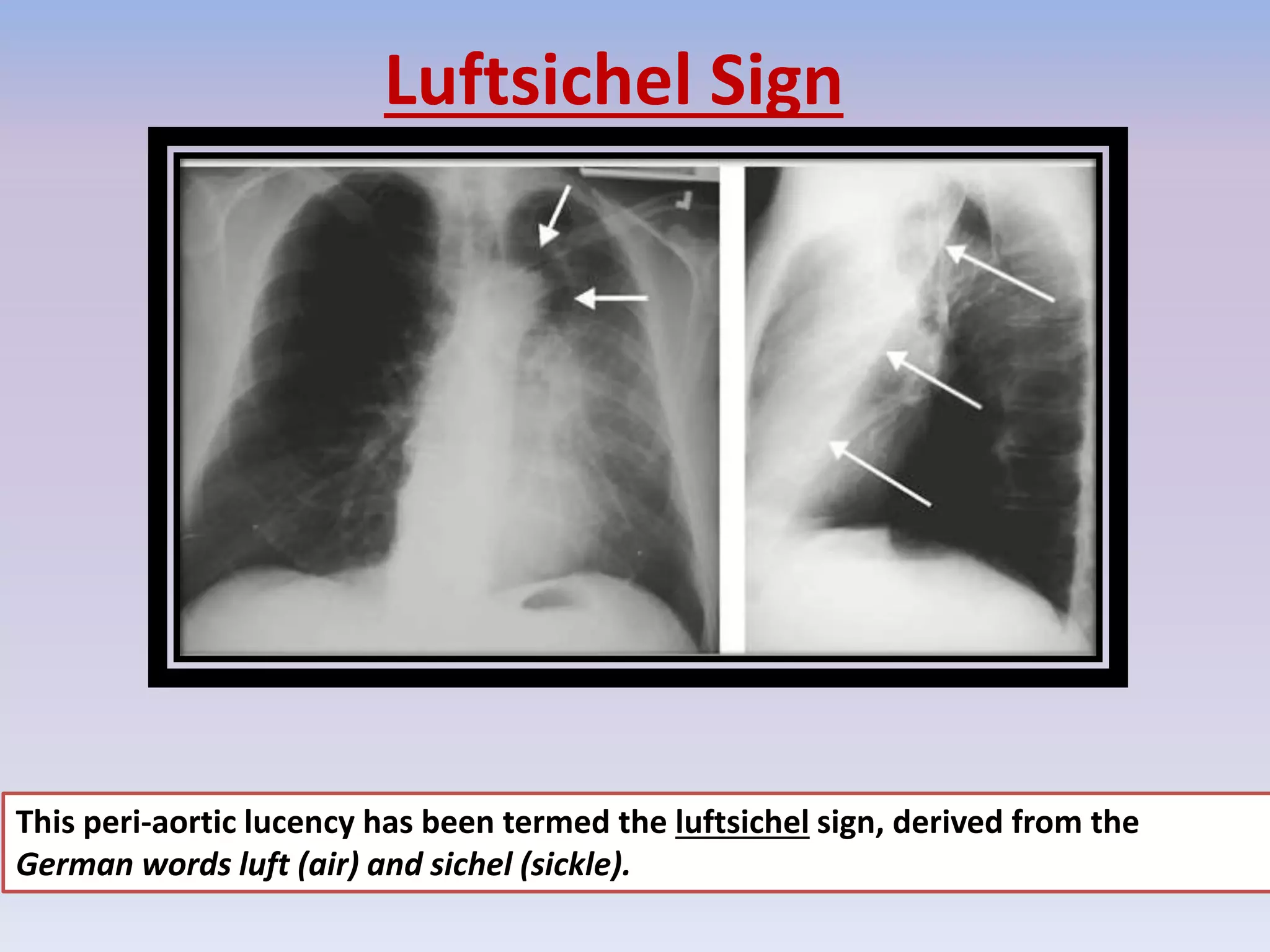 Luftcycle Sign Signs in Chest Xray | PPTX
