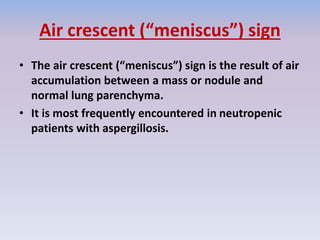 Air crescent (“meniscus”) sign
• The air crescent (“meniscus”) sign is the result of air
accumulation between a mass or nodule and
normal lung parenchyma.
• It is most frequently encountered in neutropenic
patients with aspergillosis.
 