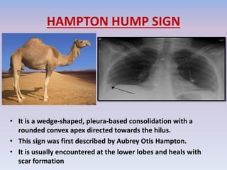 HAMPTON HUMP SIGN
• It is a wedge-shaped, pleura-based consolidation with a
rounded convex apex directed towards the hilus.
• This sign was first described by Aubrey Otis Hampton.
• It is usually encountered at the lower lobes and heals with
scar formation
 