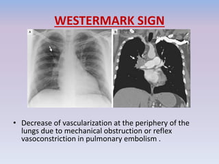 WESTERMARK SIGN
• Decrease of vascularization at the periphery of the
lungs due to mechanical obstruction or reflex
vasoconstriction in pulmonary embolism .
 