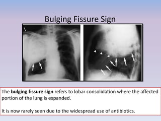 Bulging Fissure Sign
The bulging fissure sign refers to lobar consolidation where the affected
portion of the lung is expanded.
It is now rarely seen due to the widespread use of antibiotics.
 