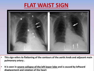 FLAT WAIST SIGN
• This sign refers to flattening of the contours of the aortic knob and adjacent main
pulmonary artery .
• It is seen in severe collapse of the left lower lobe and is caused by leftward
displacement and rotation of the heart
 