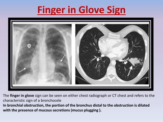 Finger in Glove Sign
The finger in glove sign can be seen on either chest radiograph or CT chest and refers to the
characteristic sign of a bronchocele
In bronchial obstruction, the portion of the bronchus distal to the obstruction is dilated
with the presence of mucous secretions (mucus plugging ).
 