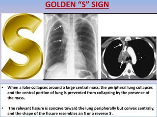 GOLDEN “S” SIGN
• When a lobe collapses around a large central mass, the peripheral lung collapses
and the central portion of lung is prevented from collapsing by the presence of
the mass.
• The relevant fissure is concave toward the lung peripherally but convex centrally,
and the shape of the fissure resembles an S or a reverse S .
 