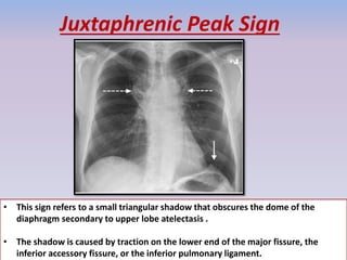 Juxtaphrenic Peak Sign
• This sign refers to a small triangular shadow that obscures the dome of the
diaphragm secondary to upper lobe atelectasis .
• The shadow is caused by traction on the lower end of the major fissure, the
inferior accessory fissure, or the inferior pulmonary ligament.
 