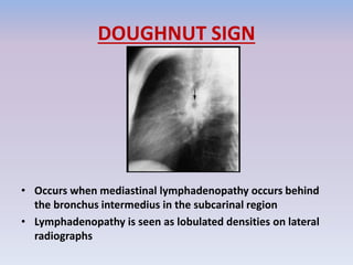 DOUGHNUT SIGN
• Occurs when mediastinal lymphadenopathy occurs behind
the bronchus intermedius in the subcarinal region
• Lymphadenopathy is seen as lobulated densities on lateral
radiographs
 