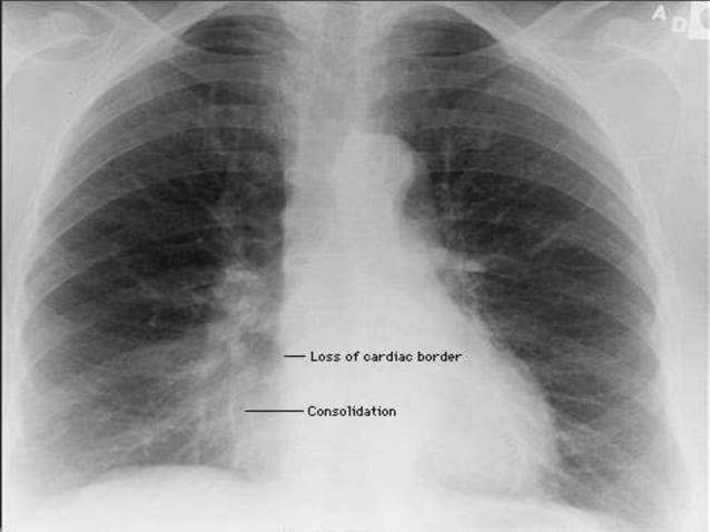 Signs in Chest Xray | PPTX | Lung and Respiratory Health | Diseases and ...