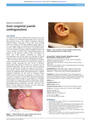 IMAGES IN PAEDIATRICS
Giant congenital juvenile
xanthogranuloma
CASE REPORT
A 1-month-old otherwise healthy girl was referred to our clinic
for evaluation of a congenital asymptomatic lesion on the face.
Upon physical exam, a ﬁrm, sharply marginated, inﬁltrative,
yellowish plaque measuring 6×4 cms with peau d’orange
surface was evident on the right mandibular region (ﬁgure 1).
A 4 mm punch biopsy was performed and histological exam
revealed a diffuse inﬁltrate of non-foamy mononuclear histio-
cytes with scattered eosinophils within the papillary dermis, and
a scarce amount of Touton cells. Immunohistochemistry was
positive for the histiocytic marker, CD68, and negative for
CD1a and S-100 protein, indicating an origin of
non-Langerhans cells. On this basis, we conﬁrmed the clinical
suspicion of giant congenital juvenile xanthogranuloma ( JXG).
JXG is the most common form of non-Langerhans cell histio-
cytosis characterised by purple-red to yellow-brown papules or
nodules, usually measuring less than 10 mm in diameter.
Lesions larger than 20 mm in diameter are extremely rare and
classiﬁed as giant JXG. The eye is the most common extracuta-
neous site affected, but virtually any organ can be involved.1–4
In our patient, systemic examinations revealed no abnormalities,
without any lymphadenopathy, hepatosplenomegaly or ophthal-
mological involvement. In the cases of cutaneous lesions
without visceral involvement, the prognosis is excellent, and a
‘wait-and-see’ strategy is recommended. Spontaneous regression
usually occurs within 6 months to 3 years (ﬁgure 2).5
The differ-
ential diagnosis of giant JXG includes mastocytoma, rhabdo-
myosarcoma, giant cell ﬁbroblastoma, juvenile nodular fasciitis,
dermatoﬁbrosarcoma protuberans and other soft tissue neo-
plasms.4
Correct diagnosis is important to avoid unnecessary
invasive procedures or aggressive treatments.
Samantha Berti,1
Giordana Coronella,2
Massimiliano Galeone,1
Riccardo Balestri,3
Annalisa Patrizi,3
Iria Neri3
1
Department of Critical Care Medicine and Surgery, Division of Dermatology,
University of Florence, Florence, Italy
2
Department of Sciences for Woman and Child’s Health, University of Florence,
Florence, Italy
3
Department of Internal Medicine, Aging and Nephrological Diseases, Dermatology,
University of Bologna, Bologna, Italy
Correspondence to Dr Massimiliano Galeone, Department of Critical Care
Medicine and Surgery, Division of Dermatology, University of Florence, Piazza
Indipendenza, 11, Florence 50129, Italy; massimiliano.galeone@gmail.com
Contributors SB: analysis and interpretation of data, and ﬁnal approval. GC:
analysis and interpretation of data, and ﬁnal approval. MG: drafting the article and
ﬁnal approval. RB: conception and design, and ﬁnal approval. AP: conception and
design, and ﬁnal approval. IN: conception and design, and ﬁnal approval.
Funding None.
Competing interests None.
Patient consent Obtained.
Provenance and peer review Not commissioned; externally peer reviewed.
To cite Berti S, Coronella G, Galeone M, et al. Arch Dis Child 2013;98:317.
Received 4 November 2012
Accepted 19 November 2012
Published Online First 12 December 2012
Arch Dis Child 2013;98:317.
doi:10.1136/archdischild-2012-303338
REFERENCES
1 Hernandez-Martin A, Baselga E, Drolet BA, et al. Juvenile xanthogranuloma. J Am
Acad Dermatol 1997;36:355–67.
2 Clayton TH, Mitra A, Holder J, et al. Congenital plaque on the chest. Diagnosis: solitary
giant congenital juvenile xanthogranuloma. Clin Exp Dermatol 2007;32:613–14.
3 Ceyhan AM, Aynali G, Chen W, et al. Congenital giant juvenile xanthogranuloma
initially masquerading as hemangioma. Eur J Dermatol 2011;21:431–3.
4 Yazganoglu KD, Erdem Y, Buyukbabani N, et al. A giant congenital plaque. Pediatr
Dermatol 2012;29:217–18.
5 Dincaslan HU, Emir S, Apaydin S, et al. An infant with giant juvenile xanthogranuloma
presenting as an axillary mass. Pediatr Blood Cancer 2008;51:713–14.Figure 1 Yellowish plaque with a peau d’orange surface and an
erythematous rim on the right mandibular region.
Figure 2 After 18 months, the lesion partially resolved leaving
residual hyperpigmentation and slight atrophy.
Arch Dis Child April 2013 Vol 98 No 4 317
PostScript
group.bmj.comon July 3, 2013 - Published byadc.bmj.comDownloaded from
 