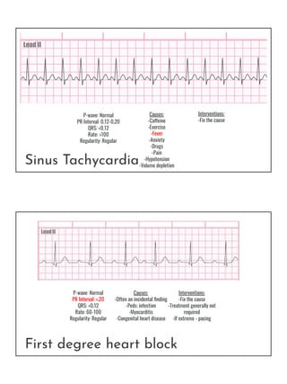 Sinus Tachycardia
P-wave: Normal
PR Interval: 0.12-0.20
QRS: <0.12
Rate: >100
Regularity: Regular
Causes:
-Caffeine
-Exerc...