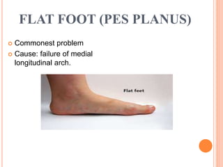 FLAT FOOT (PES PLANUS)
 Commonest problem
 Cause: failure of medial
longitudinal arch.
 