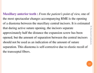 17
Maxillary anterior teeth : From the patient’s point of view, one of
the most spectacular changes accompanying RME is the opening
of a diastema between the maxillary central incisors. It is estimated
that during active suture opening, the incisors separate
approximately half the distance the expansion screw has been
opened, but the amount of separation between the central incisors
should not be used as an indication of the amount of suture
separation. This diastema is self-corrective due to elastic recoil of
the transseptal fibers.
DrRavikanthLakkakula
 