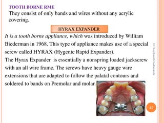 27
It is a tooth borne appliance, which was introduced by William
Biederman in 1968. This type of appliance makes use of a special
screw called HYRAX (Hygenic Rapid Expander).
The Hyrax Expander is essentially a nonspring loaded jackscrew
with an all wire frame. The screws have heavy gauge wire
extensions that are adapted to follow the palatal contours and
soldered to bands on Premolar and molar.
HYRAX EXPANDER
TOOTH BORNE RME
They consist of only bands and wires without any acrylic
covering.
DrRavikanthLakkakula
 