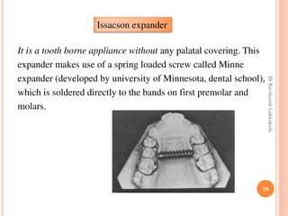 29
It is a tooth borne appliance without any palatal covering. This
expander makes use of a spring loaded screw called Minne
expander (developed by university of Minnesota, dental school),
which is soldered directly to the bands on first premolar and
molars.
Issacson expander
DrRavikanthLakkakula
 