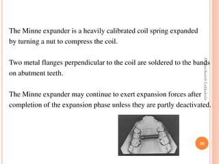 30
The Minne expander is a heavily calibrated coil spring expanded
by turning a nut to compress the coil.
Two metal flanges perpendicular to the coil are soldered to the bands
on abutment teeth.
The Minne expander may continue to exert expansion forces after
completion of the expansion phase unless they are partly deactivated.
DrRavikanthLakkakula
 