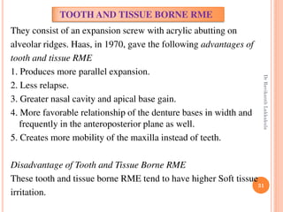 31
They consist of an expansion screw with acrylic abutting on
alveolar ridges. Haas, in 1970, gave the following advantages of
tooth and tissue RME
1. Produces more parallel expansion.
2. Less relapse.
3. Greater nasal cavity and apical base gain.
4. More favorable relationship of the denture bases in width and
frequently in the anteroposterior plane as well.
5. Creates more mobility of the maxilla instead of teeth.
Disadvantage of Tooth and Tissue Borne RME
These tooth and tissue borne RME tend to have higher Soft tissue
irritation.
TOOTH AND TISSUE BORNE RME
DrRavikanthLakkakula
 