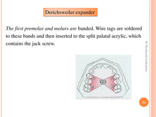 34
The first premolar and molars are banded. Wire tags are soldered
to these bands and then inserted to the split palatal acrylic, which
contains the jack screw.
Derichsweiler expander
DrRavikanthLakkakula
 