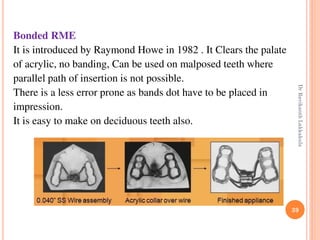 39
Bonded RME
It is introduced by Raymond Howe in 1982 . It Clears the palate
of acrylic, no banding, Can be used on malposed teeth where
parallel path of insertion is not possible.
There is a less error prone as bands dot have to be placed in
impression.
It is easy to make on deciduous teeth also.
DrRavikanthLakkakula
 