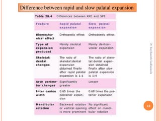 42
Difference between rapid and slow palatal expansion
DrRavikanthLakkakula
 