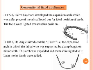 44
In 1728, Pierre Fauchard developed the expansion arch which
was a flat piece of metal scalloped out for ideal position of teeth.
The teeth were ligated towards this position.
In 1887, Dr. Angle introduced the “E arch” i.e. the expansion
arch in which the labial wire was supported by clamp bands on
molar teeth. This arch was expanded and teeth were ligated to it.
Later molar bands were added.
Conventional fixed appliances
DrRavikanthLakkakula
 