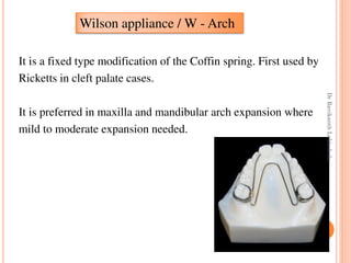 45
It is a fixed type modification of the Coffin spring. First used by
Ricketts in cleft palate cases.
It is preferred in maxilla and mandibular arch expansion where
mild to moderate expansion needed.
Wilson appliance / W - Arch
DrRavikanthLakkakula
 