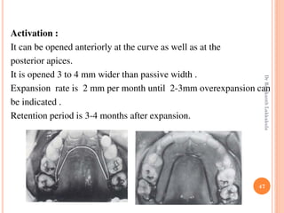 47
Activation :
It can be opened anteriorly at the curve as well as at the
posterior apices.
It is opened 3 to 4 mm wider than passive width .
Expansion rate is 2 mm per month until 2-3mm overexpansion can
be indicated .
Retention period is 3-4 months after expansion.
DrRavikanthLakkakula
 