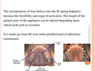 49
The incorporation of four helices into the W-spring helped to
increase the flexibility and range of activation. The length of the
palatal arms of the appliance can be altered depending upon
which teeth arch in crossbite.
It is made up 1mm SS wire either prefabricated or laboratory
constructed.
DrRavikanthLakkakula
 