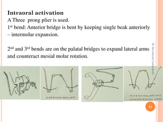 51
Intraoral activation
A Three prong plier is used.
1st bend: Anterior bridge is bent by keeping single beak anteriorly
– intermolar expansion.
2nd and 3rd bends are on the palatal bridges to expand lateral arms
and counteract mesial molar rotation.
DrRavikanthLakkakula
 