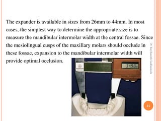 57
The expander is available in sizes from 26mm to 44mm. In most
cases, the simplest way to determine the appropriate size is to
measure the mandibular intermolar width at the central fossae. Since
the mesiolingual cusps of the maxillary molars should occlude in
these fossae, expansion to the mandibular intermolar width will
provide optimal occlusion.
DrRavikanthLakkakula
 