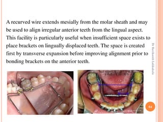 64
A recurved wire extends mesially from the molar sheath and may
be used to align irregular anterior teeth from the lingual aspect.
This facility is particularly useful when insufficient space exists to
place brackets on lingually displaced teeth. The space is created
first by transverse expansion before improving alignment prior to
bonding brackets on the anterior teeth.
DrRavikanthLakkakula
 